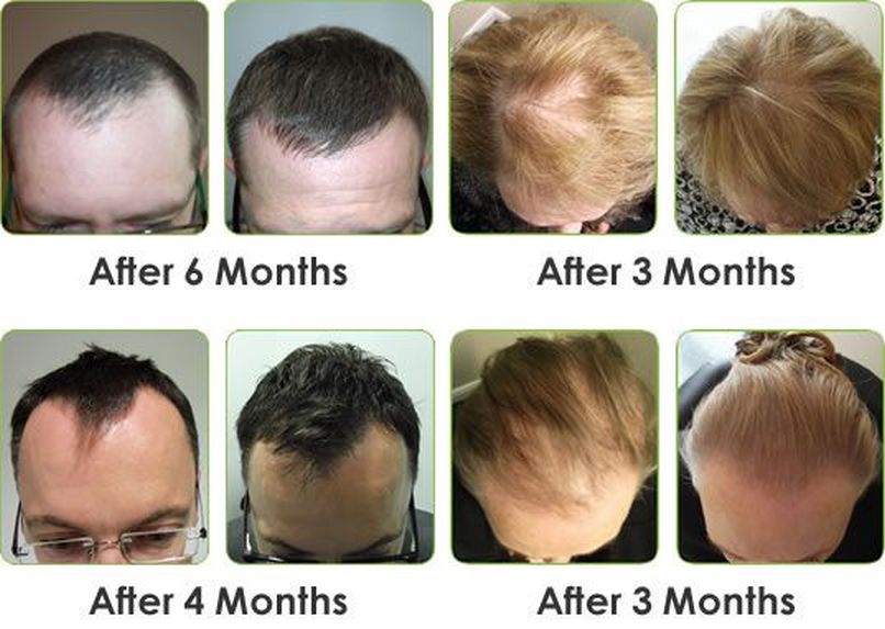 Hair Regrowth Program.jpg
