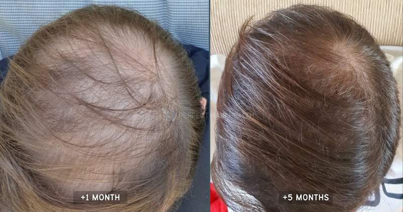 Pmano-overhead-hair-thickening-min.jpg